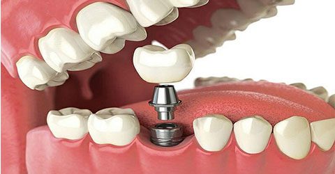 دکتر نجمه زندی پور | کاشت دندان | ایمپلنت دندان