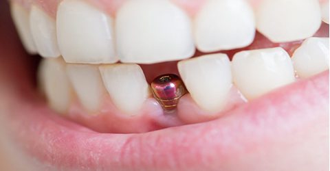 ایمپلنت دندان جلو در کرج