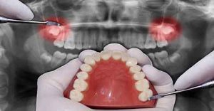 جراحی دندان عقل در چه سنی مناسب است؟