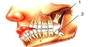 دلایل کشیدن دندان عقل