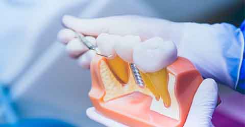 مراقبت های بعد از کاشت ایمپلنت دندان