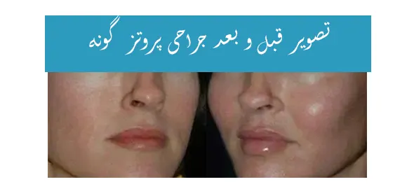 قبل و بعد عمل پروتز گونه قبل و بعد عمل پروتز گونه