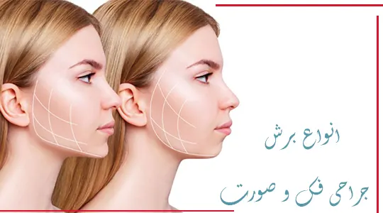 انواع برش جراحی فک و صورت
