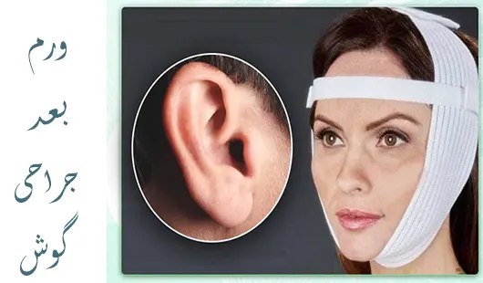 ورم بعد از عمل زیبایی گوش ورم بعد از عمل زیبایی گوش
