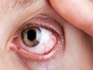 سوزش چشم بعد از عمل بینی