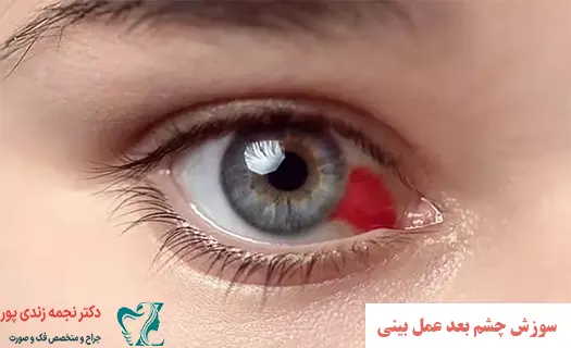 سوزش چشم بعد عمل بینی