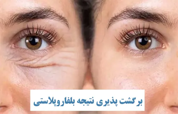 برگشت پذیری نتیجه بلفاروپلاستی