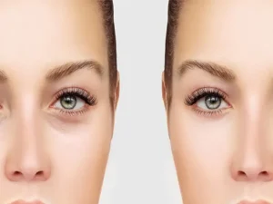 ماندگاری نتیجه بلفاروپلاستی