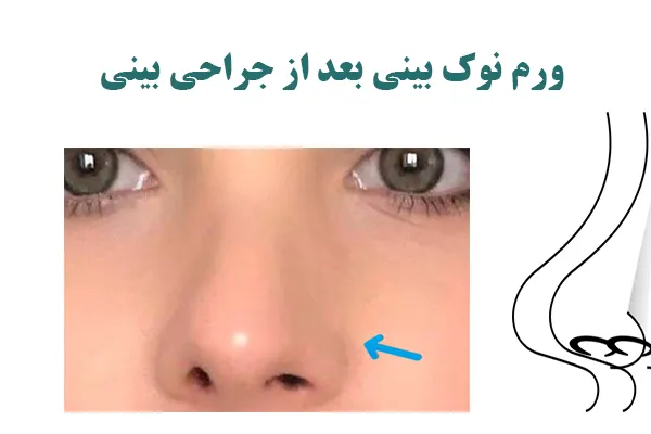 ورم نوک بینی بعد از جراحی بینی