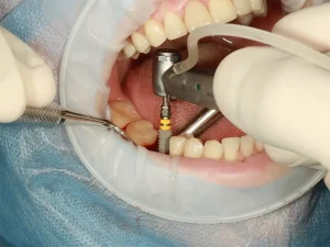 مراقبت بعد از ایمپلنت دندان