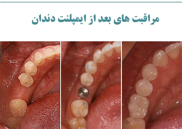 مراقبت های بعد از ایمپلنت دندان