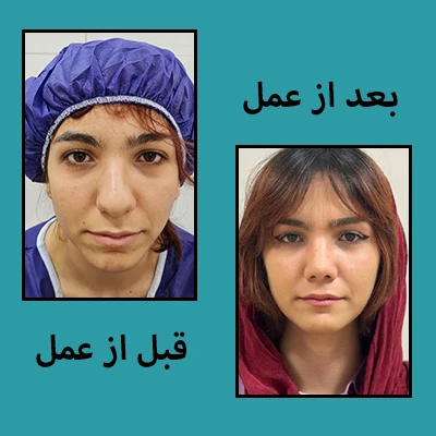 قبل و بعد از جراحی بینی 1