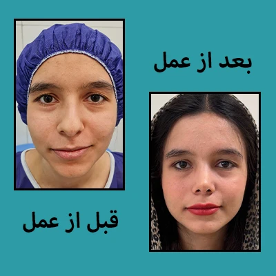 قبل و بعد جراحی بینی
