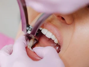 درد بعد از جراحی دندان عقل + جدیدترین داروی موثر