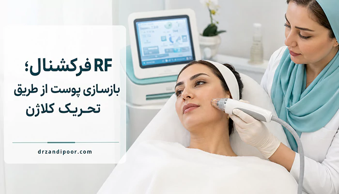 مزایا rf فرکشنال